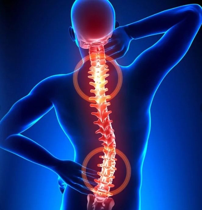 Osteochondroza szyjna – skuteczne leczenie i profilaktyka